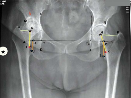 Illustration 3 for Maximize Success: Preoperative planning in primary Hip Replacement