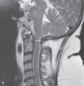 Illustration 24 for Spine Cases: Consider the Patient for Accurate Diagnosis