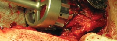 Illustration 48 for Figure Hip Resurfacing: Who Benefits and Who Should Avoid It?