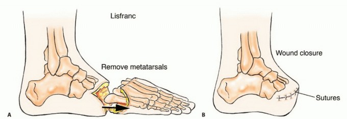 Illustration 25 for Treating Tumors of the Foot: Optimizing Amputation & Resection