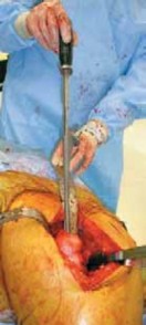 Illustration 31 for Advanced Arthroplasty for Malignant Lesions: Reclaim Your Mobility