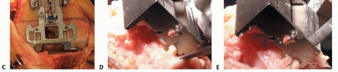 Illustration 26 for Achieve Lasting Pain Relief with Cemented Total Knee Arthroplasty