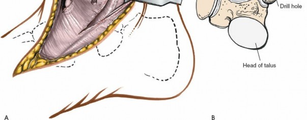 Illustration 8 for Step-by-Step Medial Side of the Ankle Approach Guide