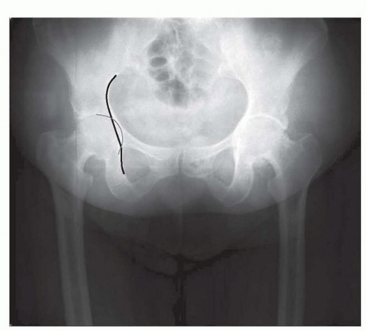 Illustration 9 for Anterior FAI Relief: Mini-Open Anterior Approach Explained