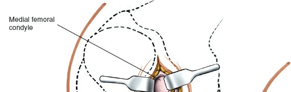 Illustration 52 for Mastering Knee Approaches: Spotlight on Superficial Medial Ligament