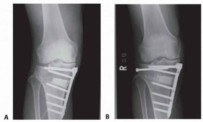 Illustration 29 for High Tibial Osteotomy: Realignment for Lasting Knee Pain Relief