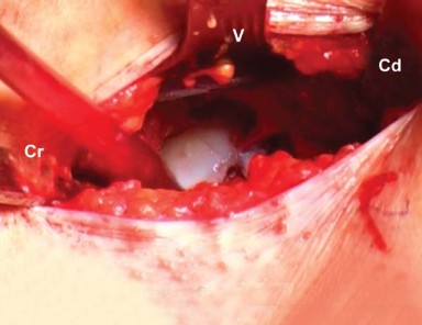 Illustration 8 for Mastering the Anterolateral Approach in Minimally Invasive Hip Replacement