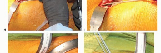 Illustration 33 for Anterior FAI Relief: Mini-Open Anterior Approach Explained