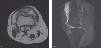 Illustration of oncology cases pvns - Dr. Mohammed Hutaif