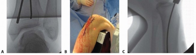 Illustration 35 for Optimizing Intramedullary Nailing for Tibial Shaft Fractures