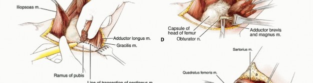 Illustration 12 for Mastering Hip Disarticulation: Through the Hip Joint Capsule