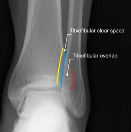 Illustration of fracture ankle fracture ankle - Dr. Mohammed Hutaif