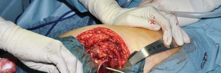 Illustration 31 for Collum Femoris Preserving: Achieve Better Primary Hip Outcomes