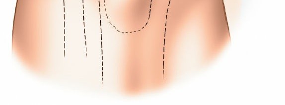 Illustration 7 for Mastering Knee Approaches: Spotlight on Superficial Medial Ligament