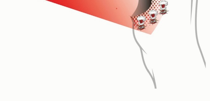 Illustration 10 for Targeted Ablation of Musculoskeletal Tumors: A Safer Approach