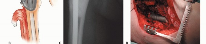 Illustration 21 for Mastering Femoral Metastases: Optimal Function for Femoris & Vastus