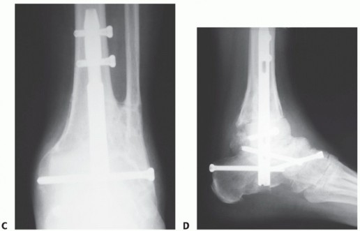 Illustration 39 for Unlock Stability: Medullary Nail Fixation for Tibiotalocalcaneal Arthrodesis