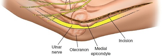 Illustration 85 for Mastering the Approach to the Distal Humerus: Safety & Skills
