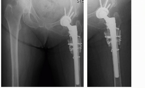 Illustration 7 for Mastering Femoral Head Autograft in DDH Hip Reconstruction