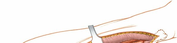 Illustration 49 for Mastering Approaches to the Upper Third of the Radius