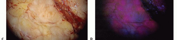 Illustration 18 for Targeted Ablation of Musculoskeletal Tumors: A Safer Approach