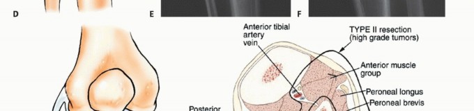 Illustration 12 for Beyond Amputation: The Type I Resection in Fibular Tumor Surgery