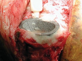 Illustration 15 for Porous Metal Cones: Biologic Fixation for Severe Bone Loss