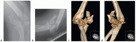 Mastering Supracondylar & Intercondylar Fracture Fixation