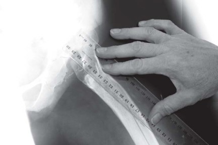 Illustration 14 for Successful Total Hip Replacement in Developmental Dysplasia