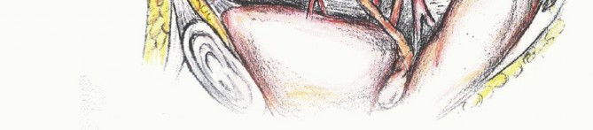 Illustration 9 for Sacral Tumor Surgery: Safeguarding Bowel & Bladder Control