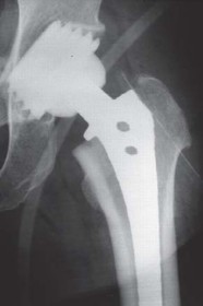 Illustration 30 for Mastering Hip Arthroplasty: Its Evolution and Design Unveiled