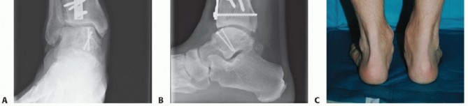Illustration 46 for Unlock Healing: Medial Malleolar Osteotomy for Talus OLT Allografts