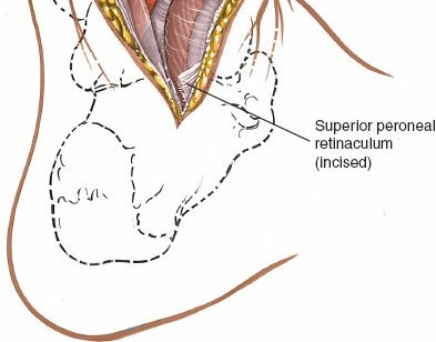 Illustration 75 for Optimized Approaches to the Dorsum of the Foot & Ankle