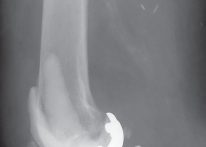 Illustration 39 for PROSTALAC Articulating Spacer: Treat Infected Knees, Regain Mobility