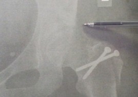 Illustration 2 for Surgical Hip Dislocation for Repair of the Labrum & CAM Lesion