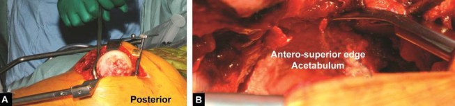 Illustration 49 for Birmingham Hip Resurfacing Designer's Technique for Active Lives