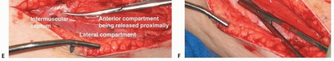 Illustration 14 for Acute Compartment Syndrome: Timely Fasciotomy Explained