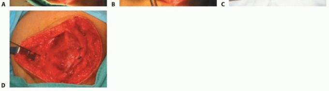 Illustration 17 for Chronic Patellar Instability: From Acute Onset to Lasting Solutions