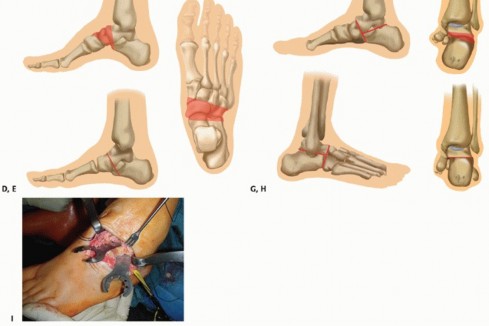 Illustration 32 for How Achilles Tendon Lengthening Fixes Equinocavovarus Foot
