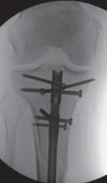 Illustration 57 for Optimal Nailing of the Tibia: Techniques for Challenging Fractures