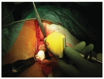 Illustration 30 for Why Polished Tapered Cemented Stems Excel in Hip Replacement