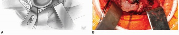 صورة طبية: النهج الأمامي لاستبدال مفصل الورك الكلي: ثورة في جراحة الورك مع الأستاذ الدكتور محمد هطيف في صنعاء