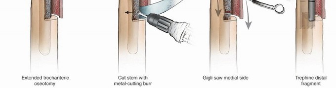 Illustration 24 for Extensively Porouscoated Stems: Proven Success & Superior Fixation
