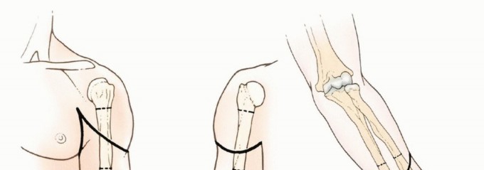 Above-Elbow & Below-Elbow Amputations: When & Why They're Needed