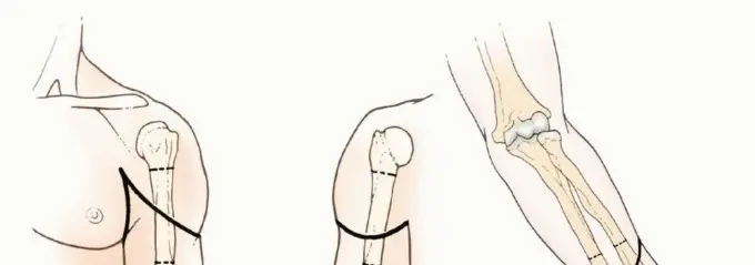 بتر الذراع فوق وتحت الكوع: متى ولماذا يصبح ضرورة طبية؟ دليل شامل من الأستاذ الدكتور محمد هطيف