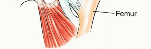 Illustration 6 for Pelvic Metastasis Surgery: A Component of the Utilitarian Approach