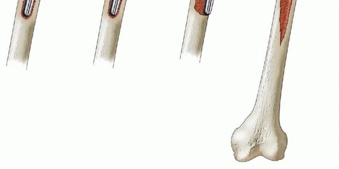 Illustration 4 for Exeter Hip Unit: Mastering Impaction Allografting for Femoral Bone Loss