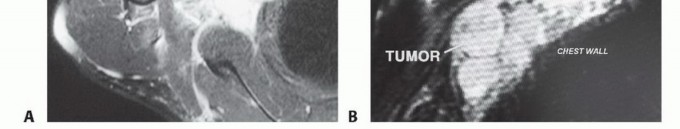 Illustration 6 for Axillary Space Exploration: Surgical Resection of Complex Tumors