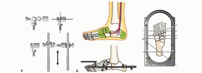 Illustration 17 for Beyond Amputation: Circular Fixation for Infection of the Talus