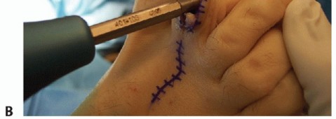 Illustration 32 for Hammer Toe Correction: Understanding the Extensor Digitorum Longus